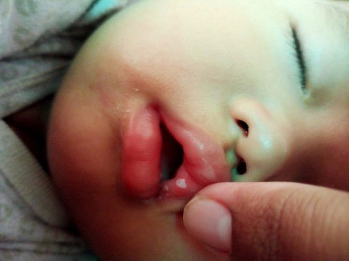 Sariawan baby 9 bln 4 hari