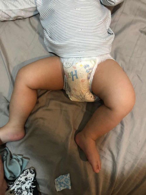 Paha Bengkak pasca DPT 3