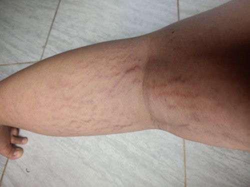 Cara menghilangkan strechtmark