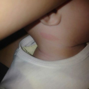 Bercak lingkaran merah