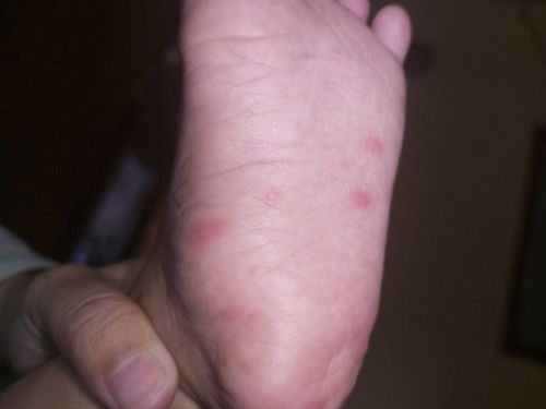 Bintik seperti cacar air di telapak kaki dan lutut anak 14 bulan
