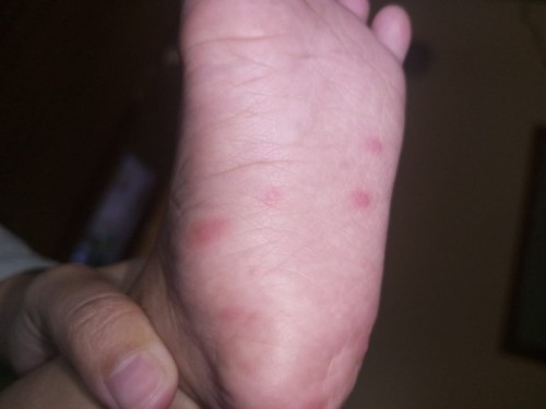 Bintik seperti cacar air di telapak kaki dan lutut anak 14 bulan