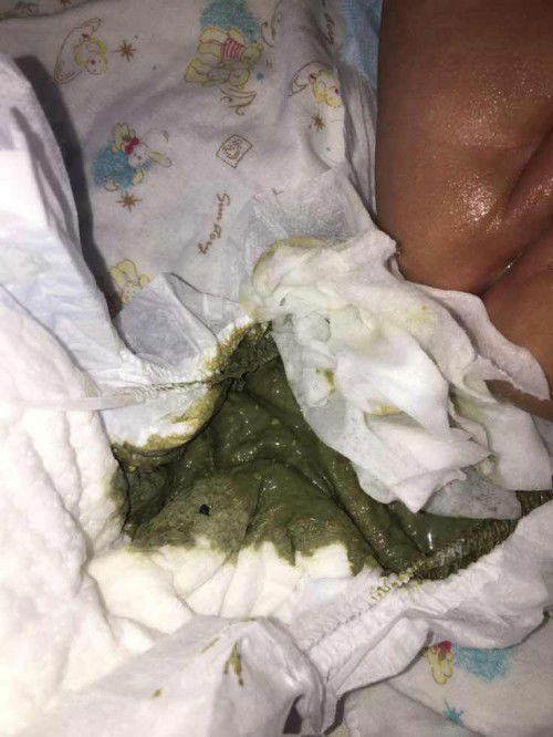 อุจจาระทารก