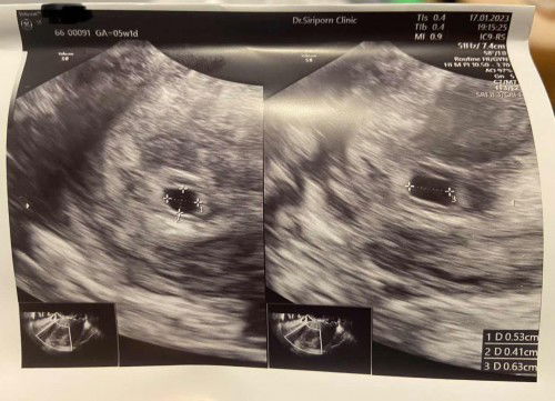 พรุ่งนี้นัดหมอ ตื่นเต้นและกังวลมากค่ะ