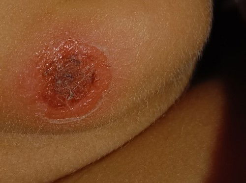 Luka di bagian dagu kanan