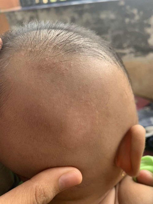 Kepala bayi ada putih2 seperti ini apakah panu? 😭 atau apa ya bun