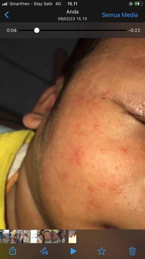 ruam kemerahan dipipi