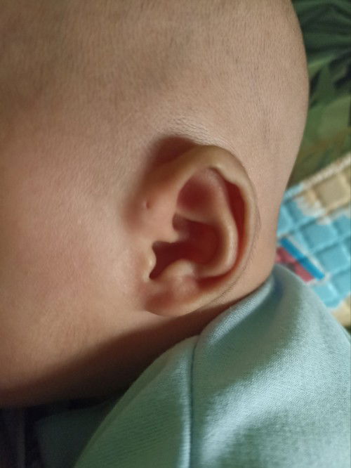 Ada lubang kecil di telinga