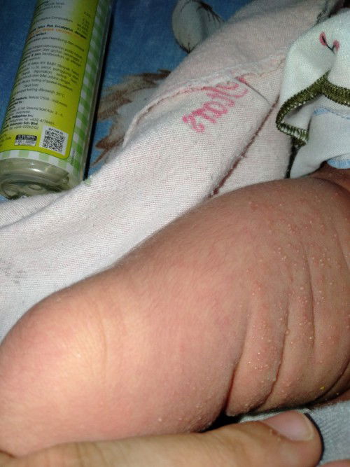 Kulit bayi bintik-bintik