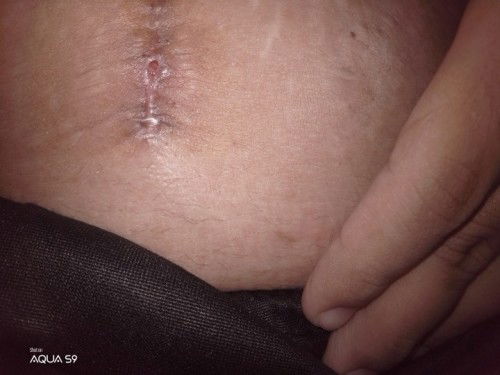 Normal delivery to CS for third baby