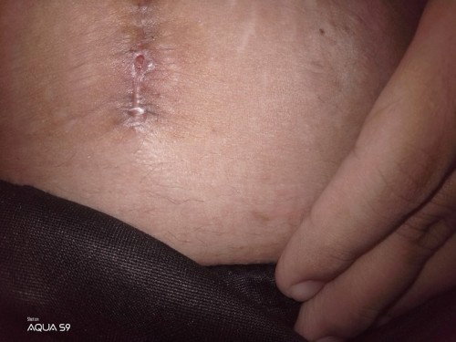 Normal delivery to CS for third baby