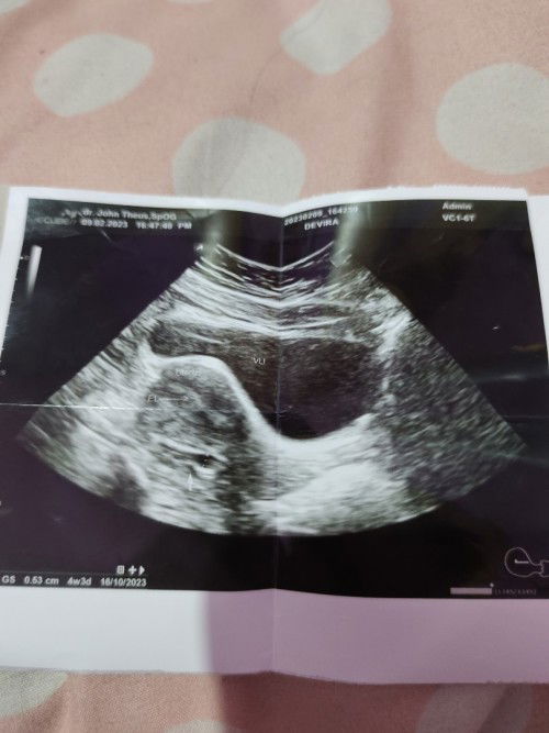 Hamil di luar kandungan