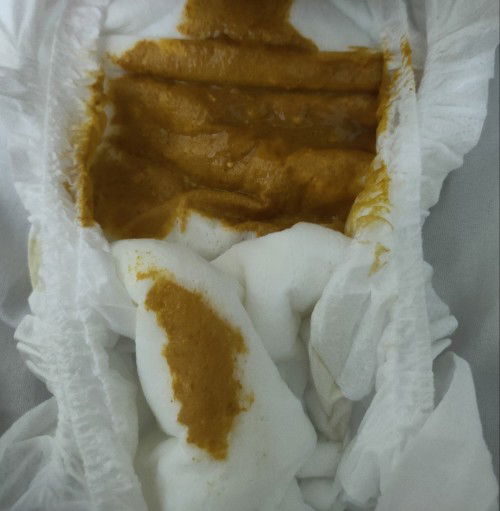 Đi ngoài phân nước