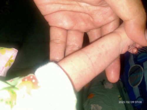 Bayiku umur 14 hari ada biang keringat d tubuh