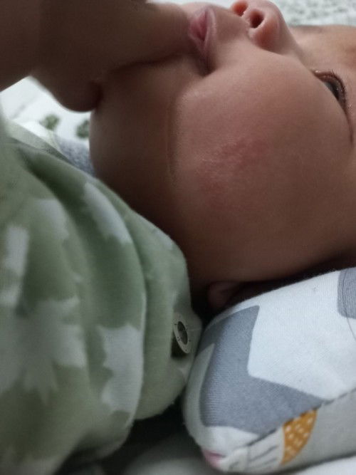 Merah dan kering di pipi