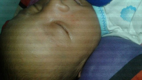 Bruntusan kecil rada merah di debay 3p hari