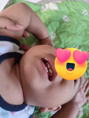 Lip tie po ba si baby? Or normal lang po na may gap pa ang teeth nya 10mos po si baby. Thank you po