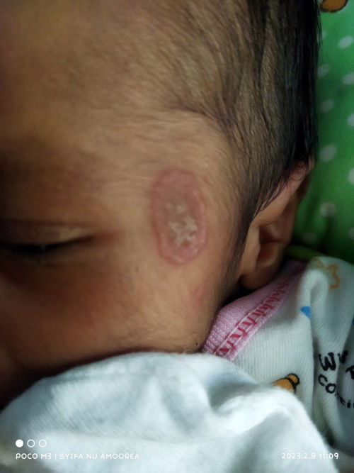 Ruam susu atau kenapa ya