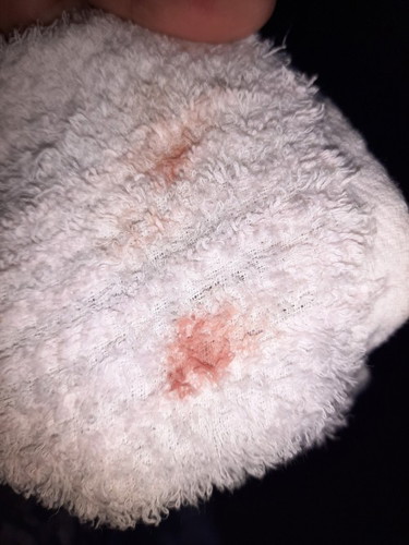 Umihi ako pagpunas ko ng bimpo may dugo na. normal po ba to? 😭