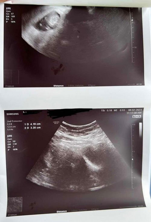 Ada Fibroid Dan Air Ketuban Kurang Diusia Kandungan 12weeks 3Days