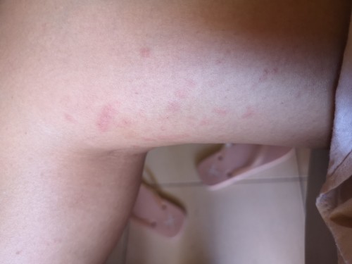 Grabe ang rashes ko pag pagpasok ng 34 weeks. Sobrang kati at kalat na sya sa Hita ko 💔💔💔