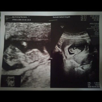 Hasil USG !