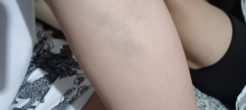 Bakit po Nung kinuhaan Ako Ng dugo,dun po sa part namamasa at umabot Ng weeks Yung pasa,dlwa braso
