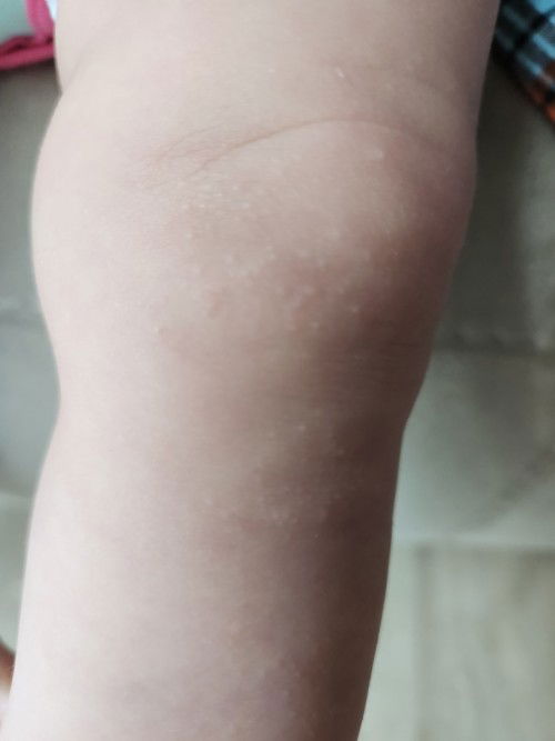 Bumps on baby's thighs