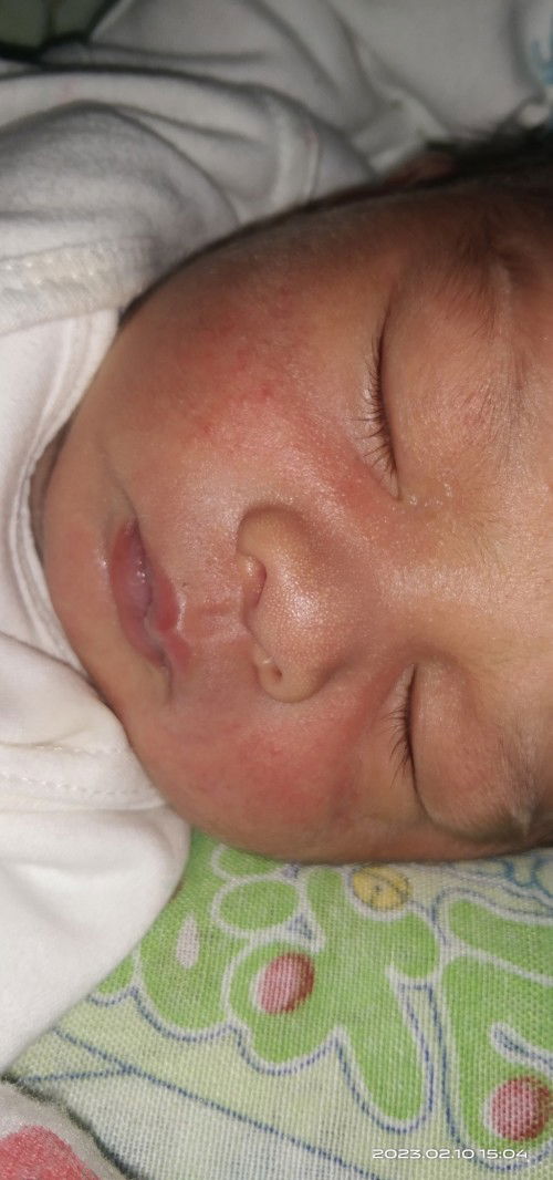 Baru 1 Minggu 4 hari,timbul bintik² merah bagian pipi kiri kanan,itu biji panas atau apa ya Bun?