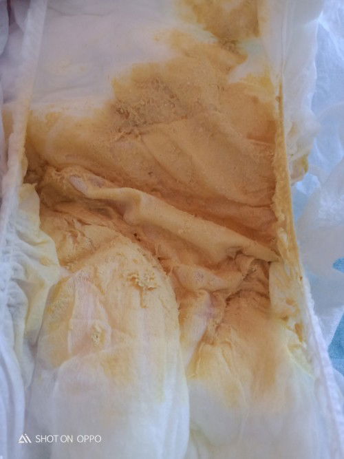 Normal pang po ba poop ni baby 9months Lactum pangalawa ng poop ngayong Araw Yung una medyo matigas