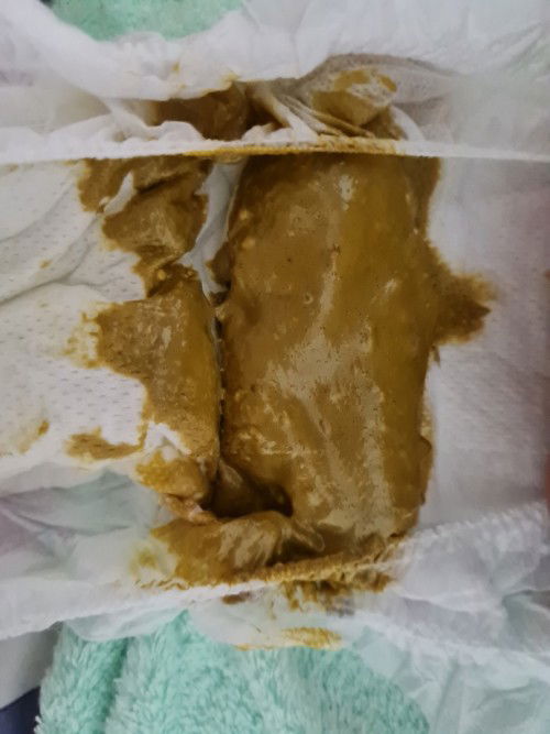 Phân bé bị lỏng đúng kh ạ
Có bọt ạ
Bé bú mẹ và ct ạ