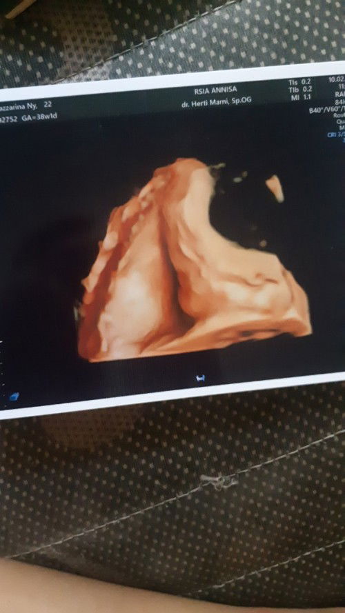 Uk janin usg akhir beda sama usg sebelumnya