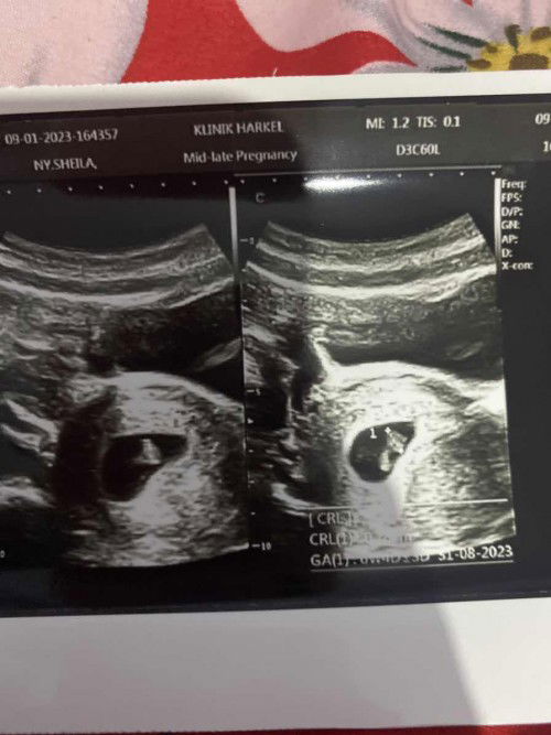 Apakah hamil anak kembar?