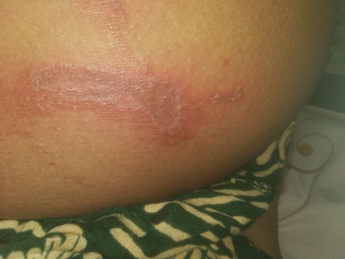 Bun ada yg pernah ngalamin ngga hamil tua tiba" Kena herpes di perut saat hamil tua, solusiny bun π