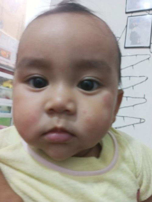Bayi 9 bulan bercak" merah