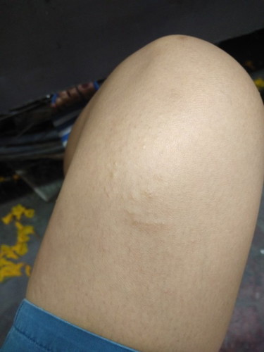 มีผื่นแดงขึ้นที่ท้อง