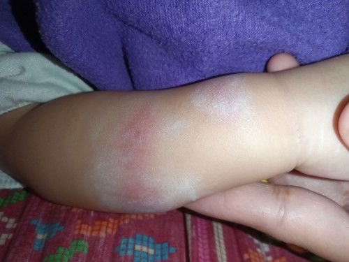 Kagat ng lamok pero diko nakita kung lamok ba tlaga.