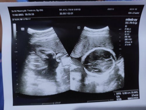 Gagal USG 4D karna dede tengkurep