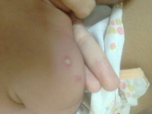 สอบถามแม่ๆหน่อยค่ะตรงที่น้องฉีดวัคซีนมีตุ่มคล้ายๆหนอง ปกติไหมคะแม่