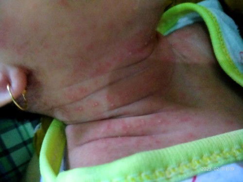 Bayi 16 hari banyak bintik merah