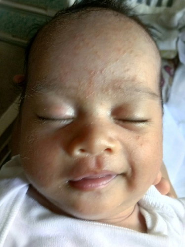 Good pm po. Ano po bang remedy sa mga tumutubo sa face ni baby? First time mom here po. Salamat