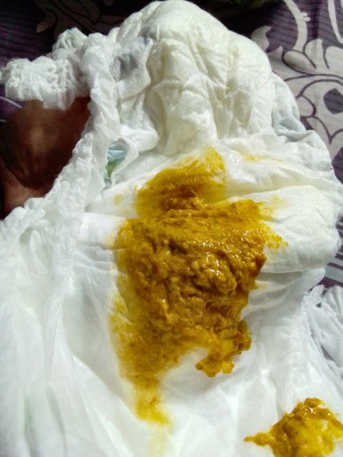 BAB lebih dari 5x, diare kah ?