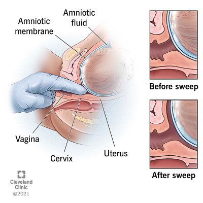 Membrane swepp / Stripping membrane
