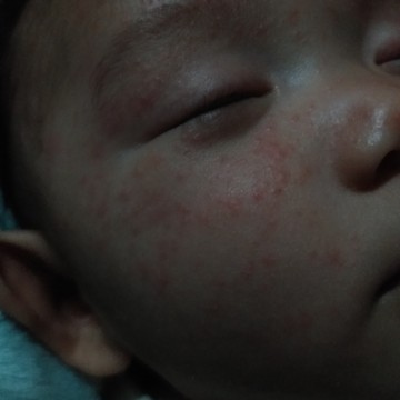 Baby face rash