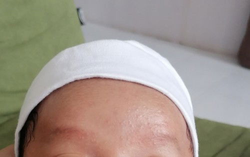 Newborn kulit muka beruntusan