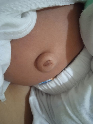 Normal lang po ba ang ganitong pusod for 6 weeks old baby?