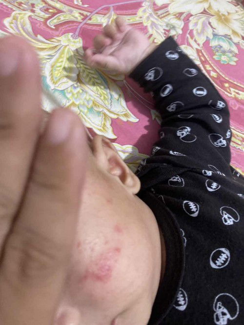 wajah bayi merah merah