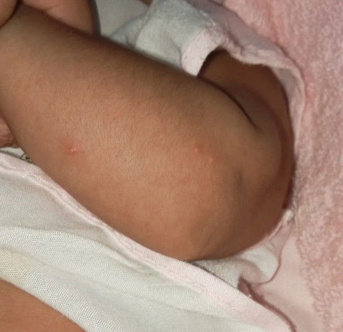 ลูกมีตุ่มใสขึ้น