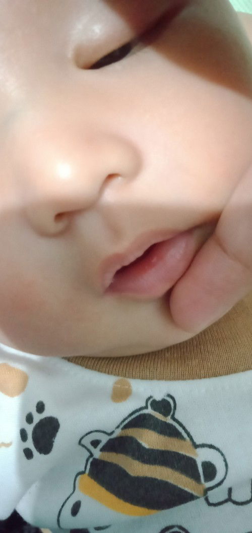 Baby 3 bulan kurang 4 hari sariawan