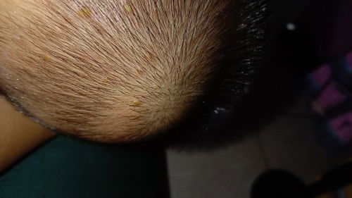 Timbul bentol bernanah di kpala bayi